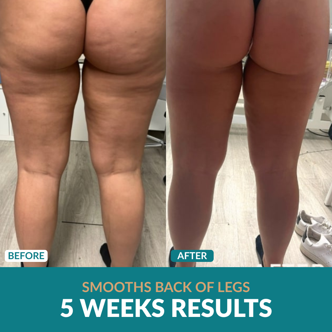 Anti-Cellulite Oil