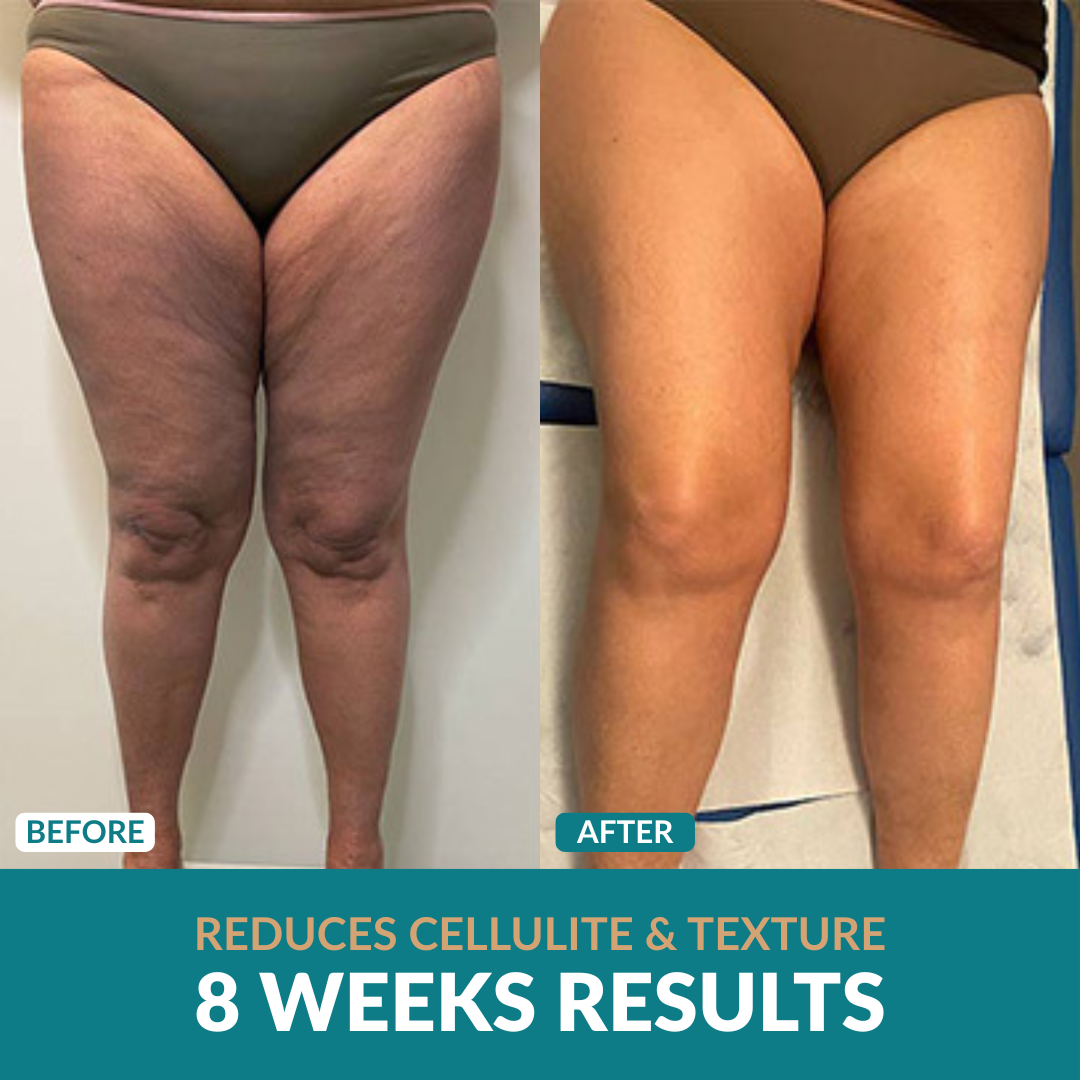 Anti-Cellulite Oil