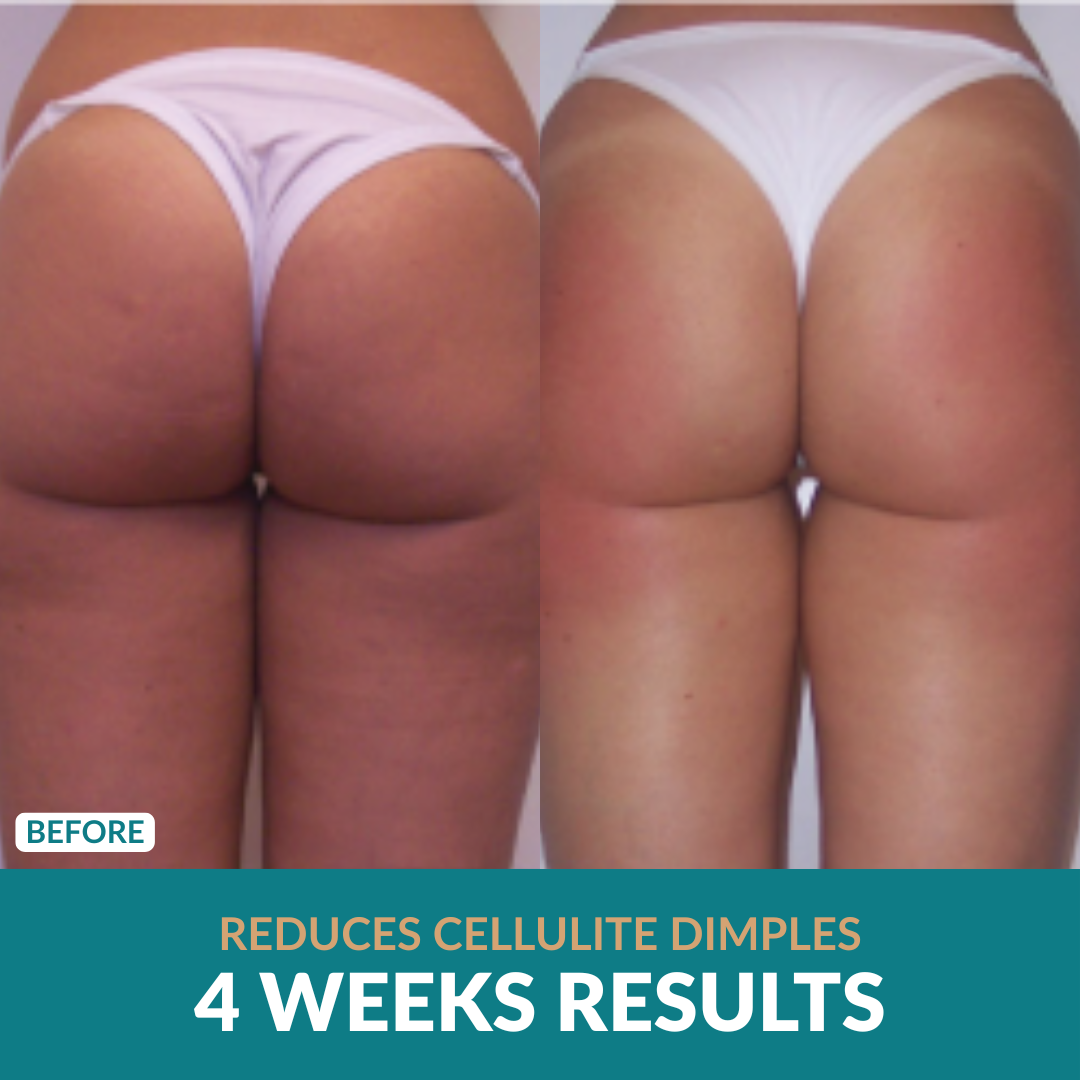 Anti-Cellulite Oil