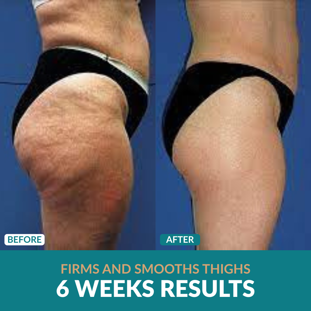 Anti-Cellulite Oil