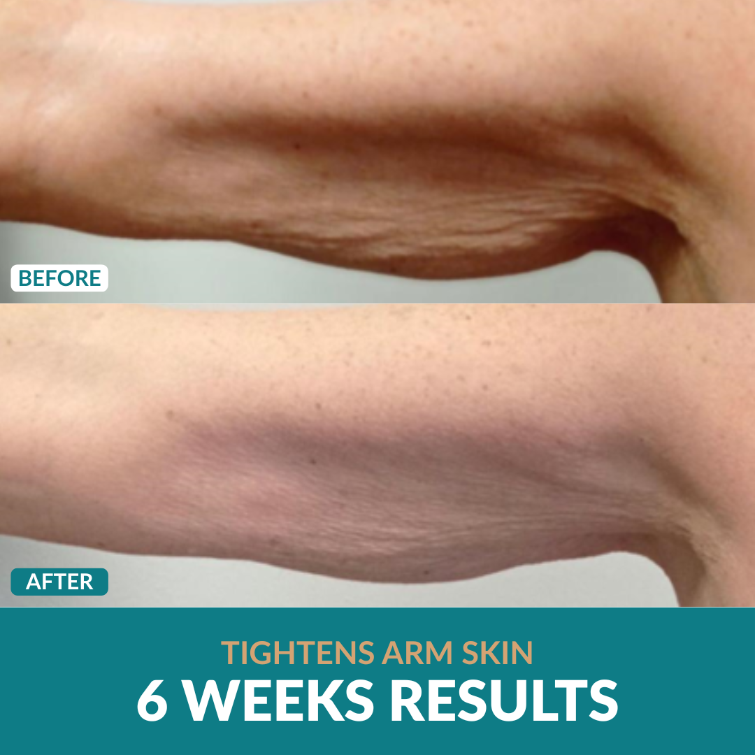 Anti-Cellulite Oil