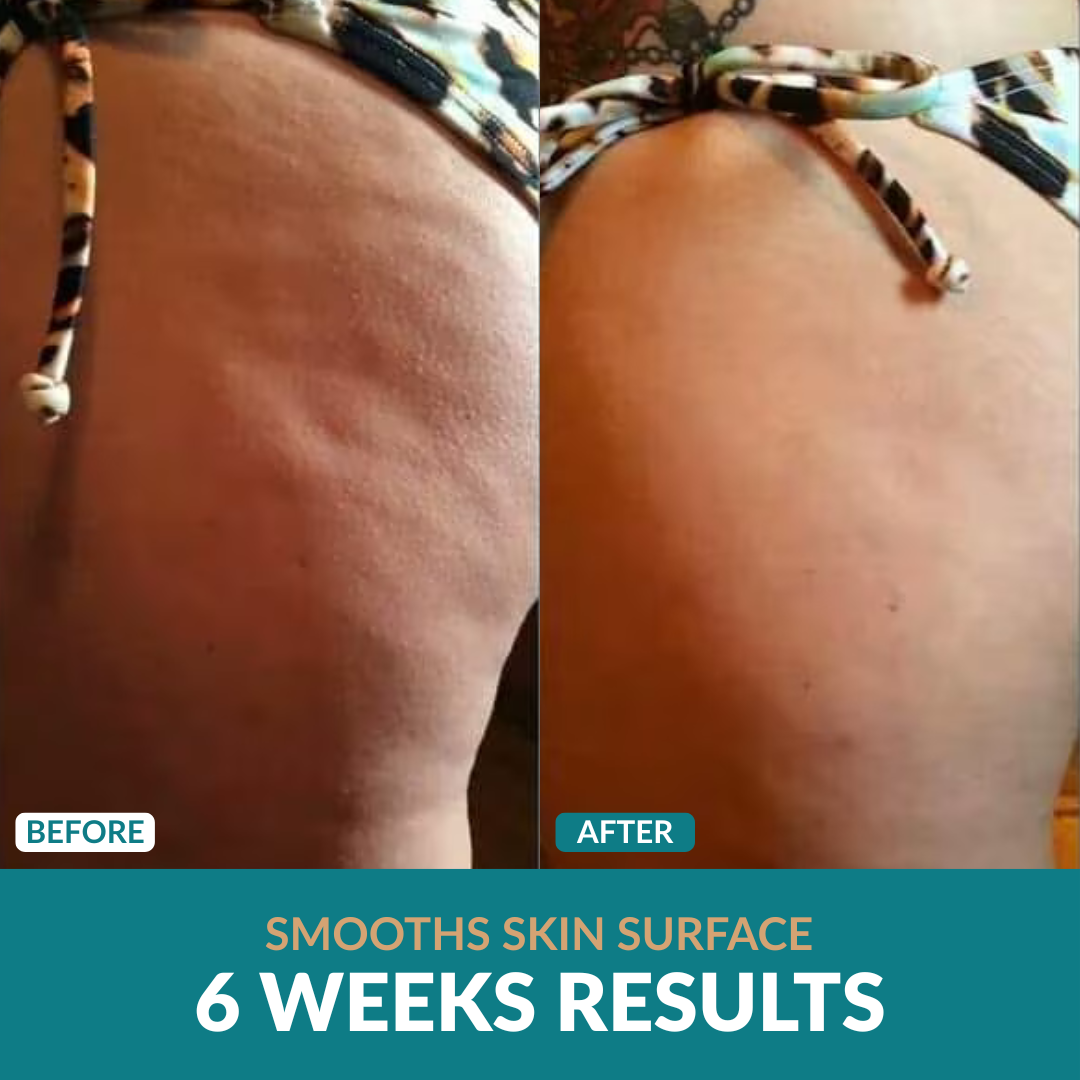 Anti-Cellulite Oil